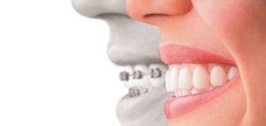 invisalign treatment arlington heights