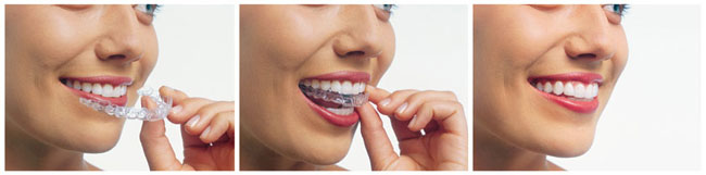 invisalign arlington heights